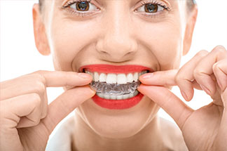 clear aligners