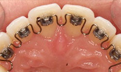 lingual braces